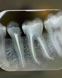 Endodonsko lecenje zuba