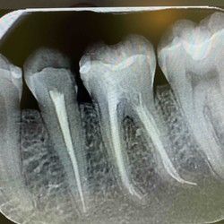 Endodonsko lecenje zuba