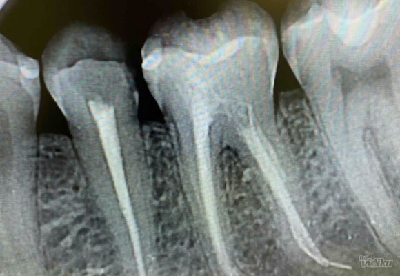 endodonsko-lecenje-zuba-81aa25.jpg