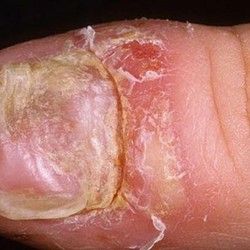 Lečenje homeopatijom psorijaze noktiju
