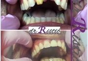 Nadoknada zuba - privremene krunice