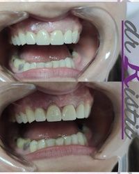 Nadogradnja zuba - krunice