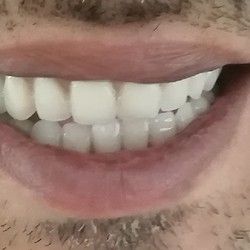 Totalna zubna proteza