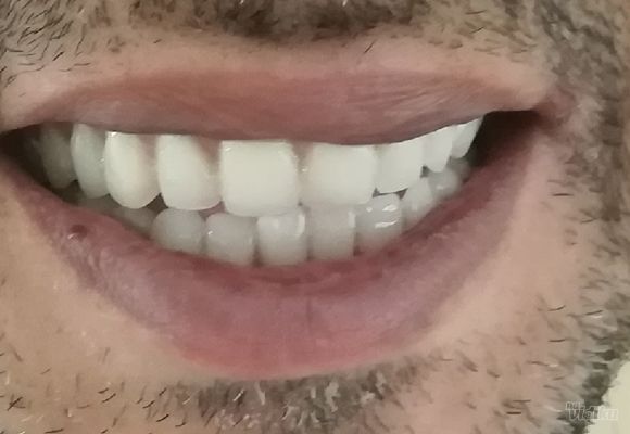 totalna-zubna-proteza-8adde7.jpg