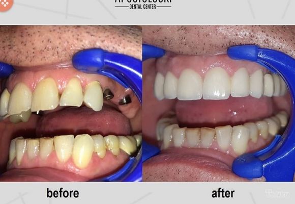 straumann-dentalni-implantat-e88794.jpg