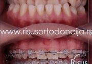 Ortodontska kamuflaža