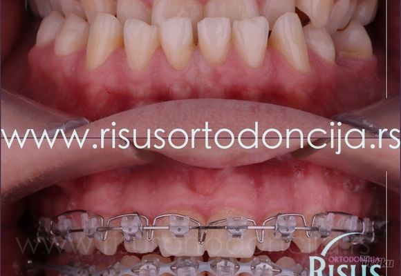 ortodontska-kamuflaza-d6f4cc.jpg