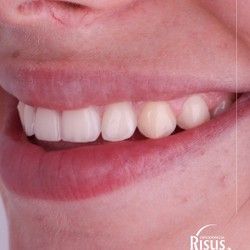 Risus Ortodoncija - Put do savrsenog osmeha