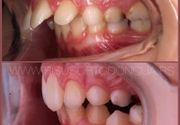 Mobilne proteze - rani ortodontski tretman za Vaše dete