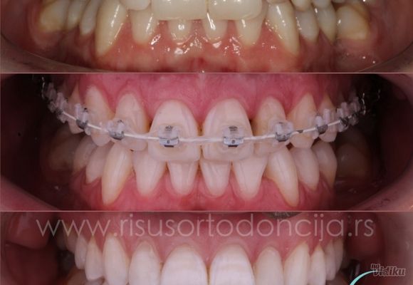 estetika-u-sluzbi-funkcije-ortodontski-tretman-157ce6-1.jpg
