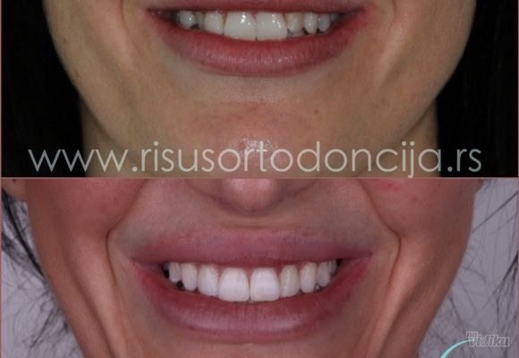 estetika-u-sluzbi-funkcije-ortodontski-tretman-157ce6-2.jpg