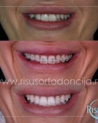 Estetika u službi funkcije - Ortodontski tretman