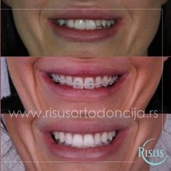 Estetika u službi funkcije - Ortodontski tretman