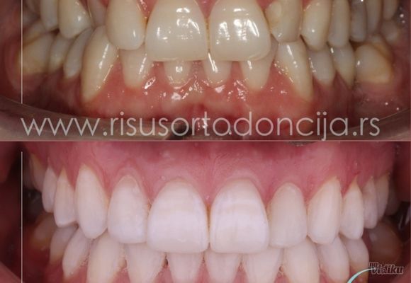 estetika-u-sluzbi-funkcije-ortodontski-tretman-157ce6-3.jpg