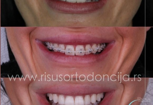 estetika-u-sluzbi-funkcije-ortodontski-tretman-157ce6.jpg