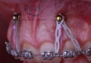 Lečenje uz najnoviju ortodontsku tehnologiju