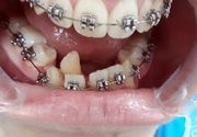 Fiksna proteza za zube Banovo brdo