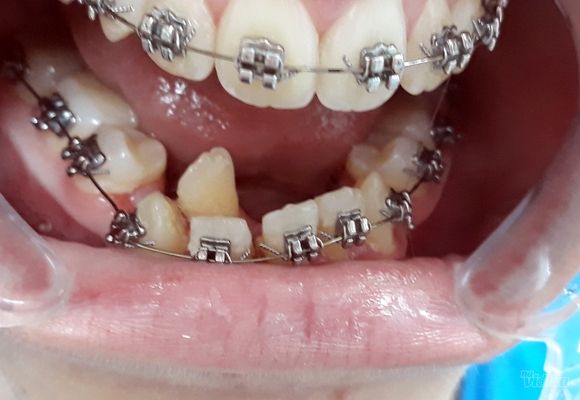 fiksna-proteza-za-zube-banovo-brdo-3dd2c6.jpg