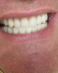 Folije za ispravljanje zuba Ortodoncija