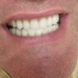Folije za ispravljanje zuba Ortodoncija