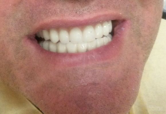 folije-za-ispravljanje-zuba-ortodoncija-138660.jpg
