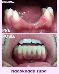 Protetska rehabilitacija zuba bezmetalnim mostom