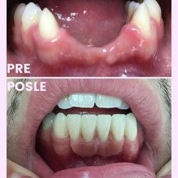 Protetska rehabilitacija zuba bezmetalnim mostom