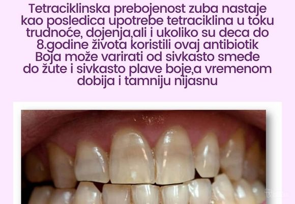 izbeljivanje-zuba-36d16e-3.jpg