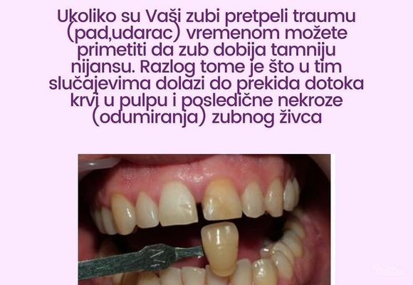 izbeljivanje-zuba-36d16e-4.jpg