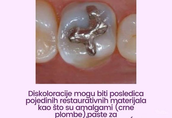 izbeljivanje-zuba-36d16e-5.jpg