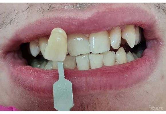profesionalno-izbeljivanje-zuba-sabac-cc080b-1.jpg