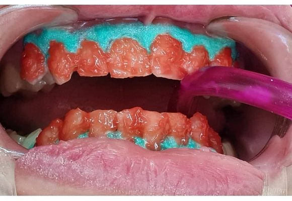 profesionalno-izbeljivanje-zuba-sabac-cc080b-2.jpg