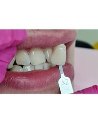 Profesionalno izbeljivanje zuba Sabac