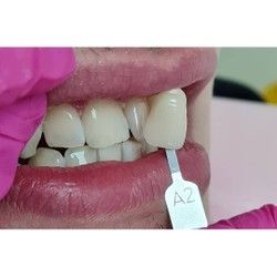 Profesionalno izbeljivanje zuba Sabac