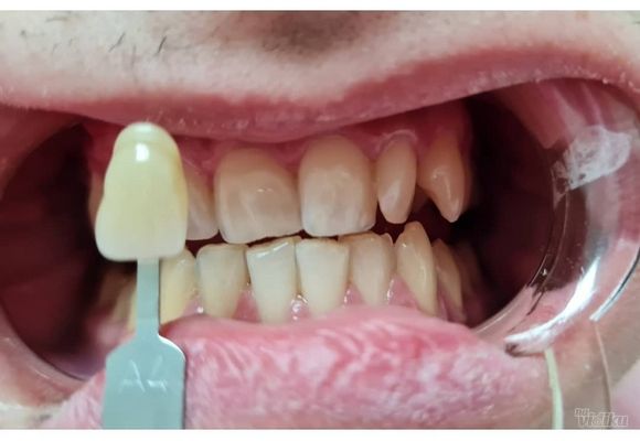 profesionalno-izbeljivanje-zuba-sabac-cc080b-3.jpg