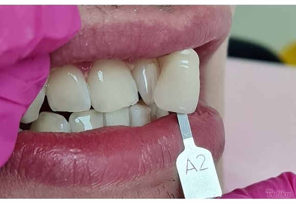profesionalno-izbeljivanje-zuba-sabac-cc080b.jpg