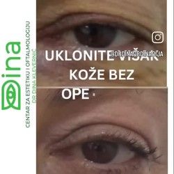 Uklanjanje viška kože iznad očiju