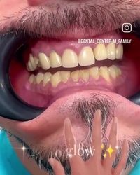 Bezbolno sređivanje zuba