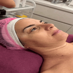 Podmlađivanje kože tretman Novi Sad