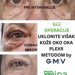 Uklanjanje viška kože na kapcima