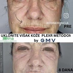 Uklanjanje viška kože na licu