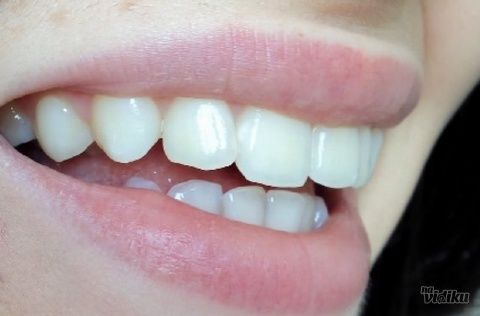 3 stomatološka tretmana koja će najbrže transformisati vaš osmeh
