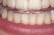 Kako se radi i koliko dugo traje ispravljanje zuba folijama?
