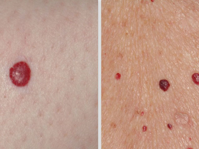 Uklanjanje benignih i malignih tumora kože