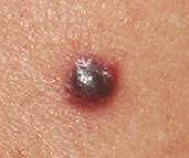 Nodularni melanom